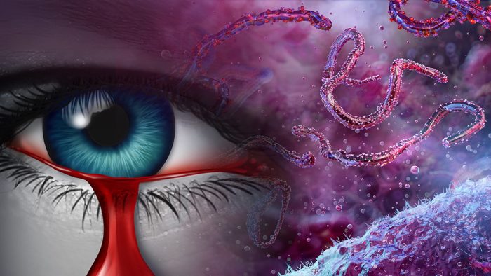 Outbreak of Incurable ‘Bleeding Eye’ Virus Leads to Travel Warnings and Concern