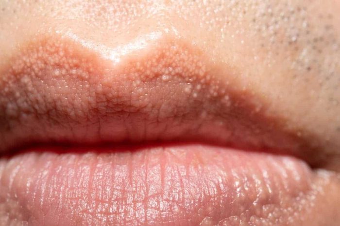 Reasons People Get Strange White Bumps on Their Lips or Private Parts